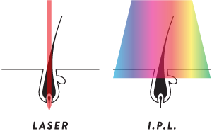 IPL-vs-Laser-Graphic.png